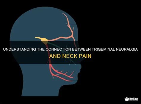 Understanding The Connection Between Trigeminal Neuralgia And Neck Pain ...