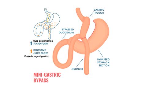 Mini Gastric Bypass - Obesity Not 4 Me.