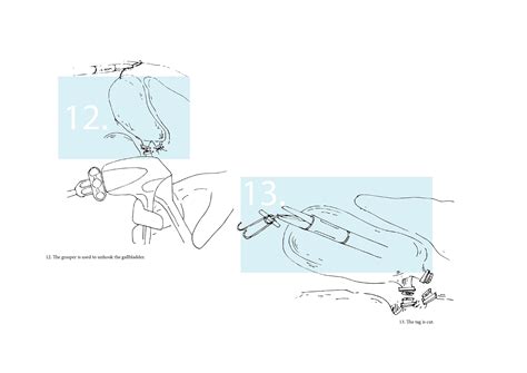 D'source Case Study - Slide Show | Deployer Device for Endo Retractor ...