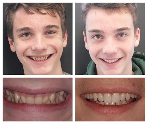 What Helps With Zingers After Teeth Whitening