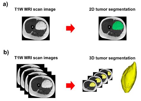 Robustness of Radiomic Features: Two-Dimensional versus Three-Dimensional MRI-Based Feature ...