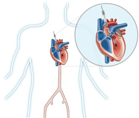 FDA likely to approve expanded indication of Abiomed's Impella heart ...