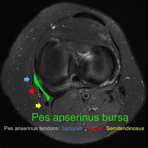Pes anserinus bursa diagram | Radiology Case | Radiopaedia.org | Pes ...
