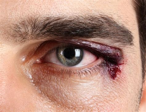 Understanding Eye Trauma