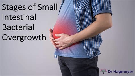 Stages of SIBO | Dr. Hagmeyer | DrHagmeyer.com