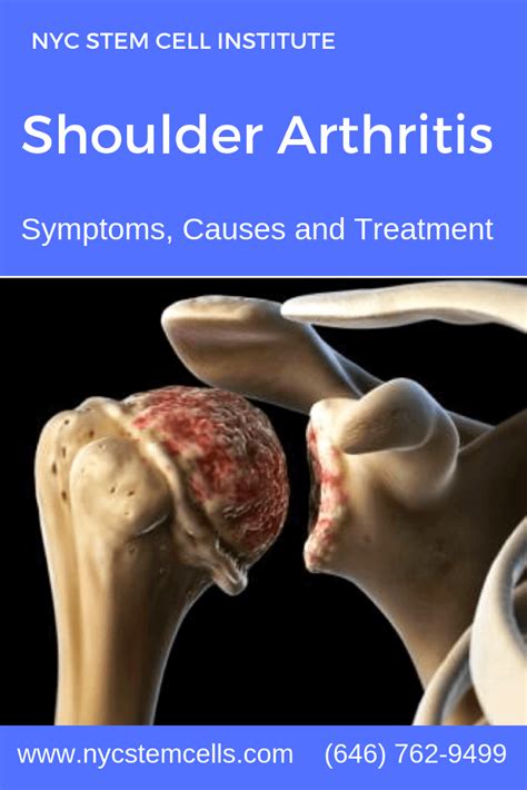 Regenerative Medicine Stem Cell Therapy for Shoulder Arthritis: | Shoulder arthritis, Stem cell ...