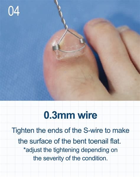 Onycho Clip - TERASYS (Domestic)