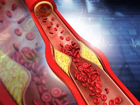 Clogged Arteries: 7 Ayurvedic Teas That Can Naturally Flush Out Bad LDL ...