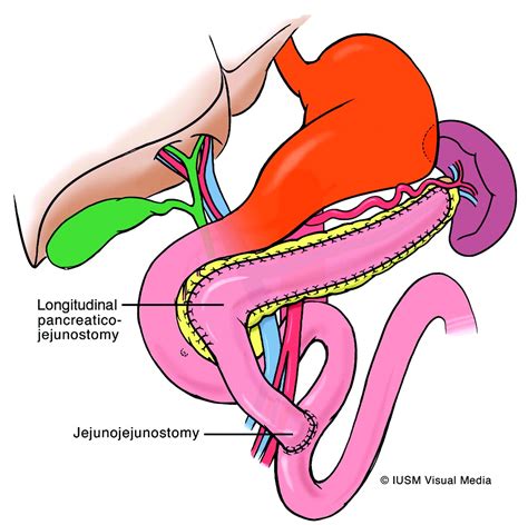 Small-Bowel Complications of Major Gastrointestinal Tract Surgery | AJR