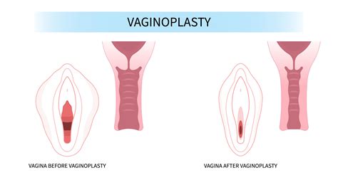 Vaginoplasty: Procedure, Cost, Risks & Benefits, Recovery