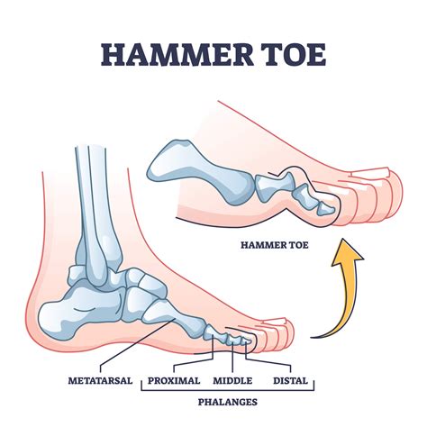 What Is Hammer Toe