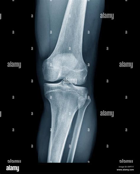 Normal knee x ray hi-res stock photography and images - Alamy