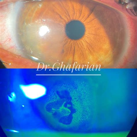 Sadegh Ghafarian on LinkedIn: #cornea #rce #recurrent_corneal_erosion #ocular_pain #ocular_trauma…