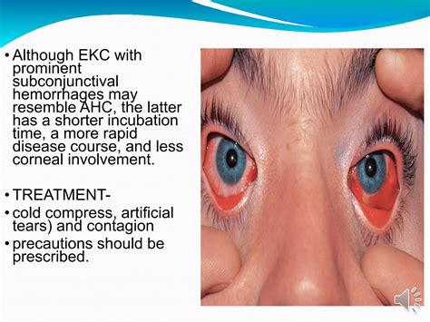 Viral conjunctivitis - DR ARNAV | PPTX