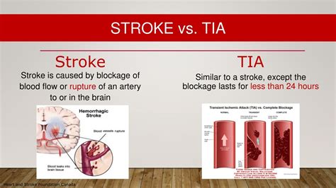 Tia Vs Stroke