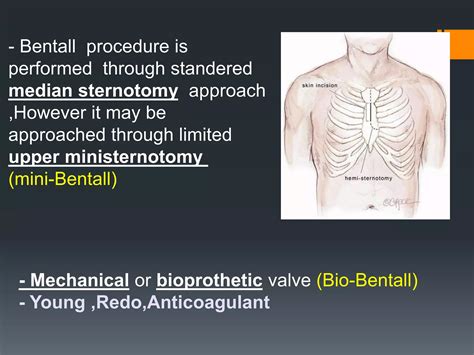 Aortic root surgery. Bentall operation | PPTX