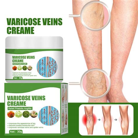 Buy Varicose Veins Cream,Varicose Veins Relief Cream Vasculitis ...