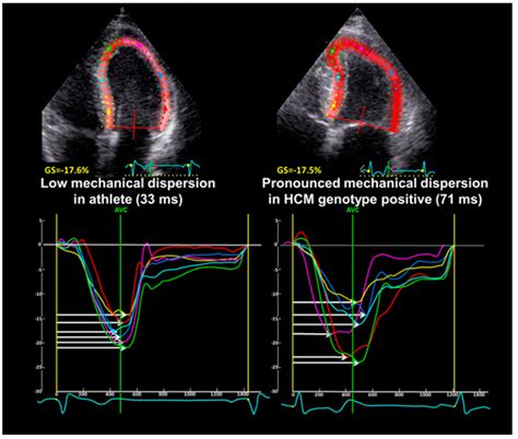 Differentiation of Myocardial Properties in Physiological Athletic ...