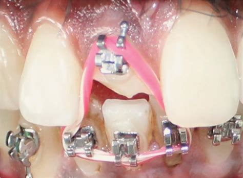 Multidisciplinary Management of Anterior Traumatized Tooth: A Case Report