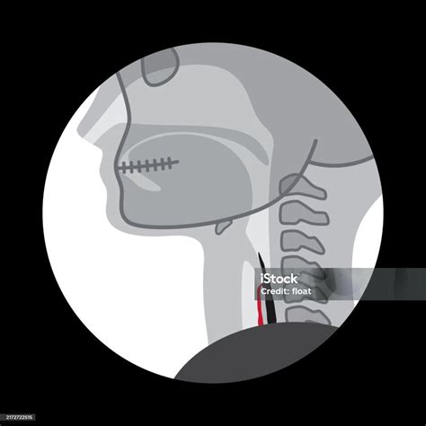 Videofluoroscopic Swallowing Study Stock Illustration - Download Image ...