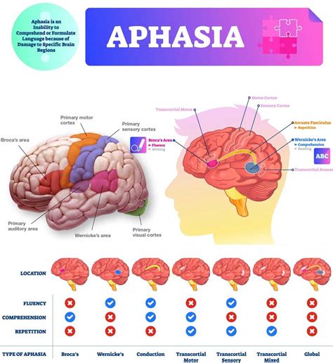 Aphasia – Artofit