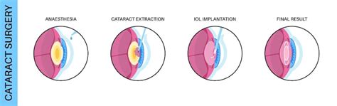 Eyes with cataracts Vectors - Download Free High-Quality Vectors from ...
