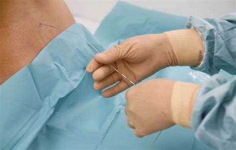 Thoracic epidural analgesia reduces hospital stay in elderly undergoing ...