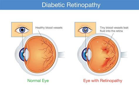 Diabetic Eye Problems 的图像结果