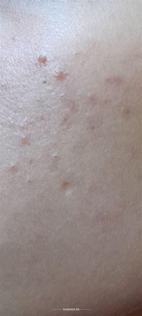 Ask a Dermatologist Online for Blackheads On Cheeks /Dry Skin