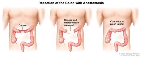 Image result for Colon Cancer Surgery Procedure
