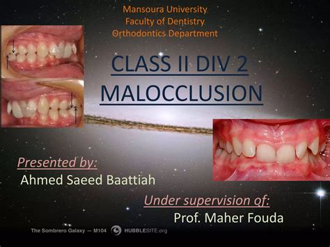 Class ii div 2 malocclusion | PPTX