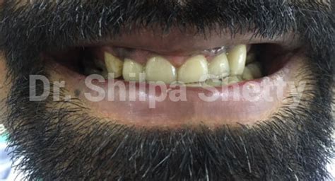 Photo Gallery | Cosmetic Dental Clinic Koramangala, Bangalore