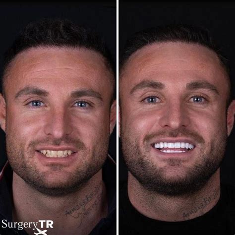 Dental Implants in Turkey (Tooth Implant) | SurgeryTR