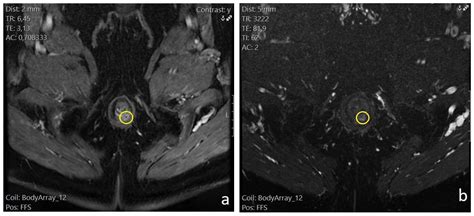 Ischiorectal Abscess Mri