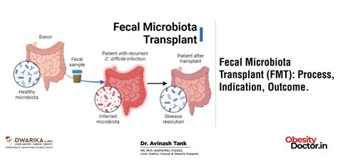 Fecal Microbiota Transplant (FMT): Process, Indication, Outcome. - Dr ...