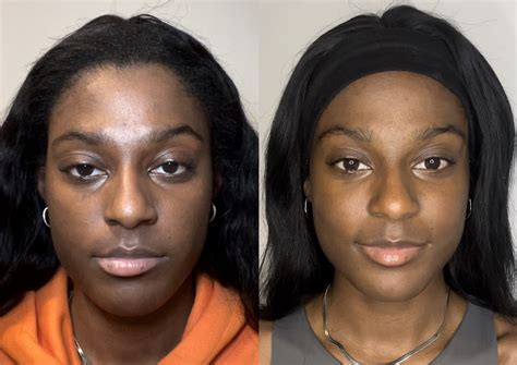 I injected salmon sperm into my face – these were the results | Dazed