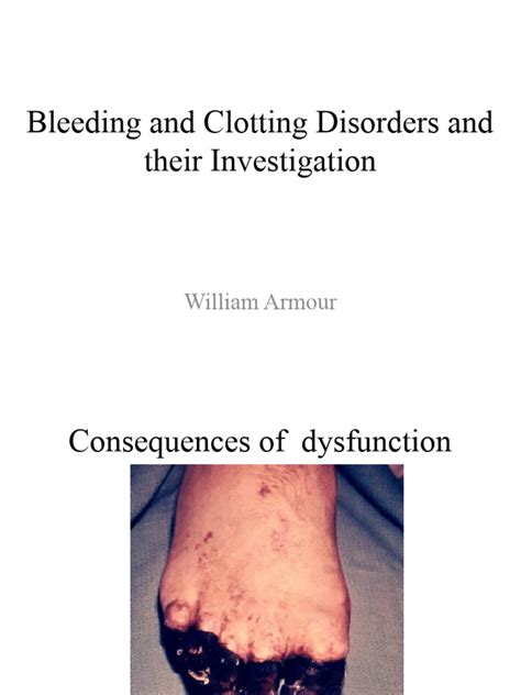 Clotting Disorders 的图像结果