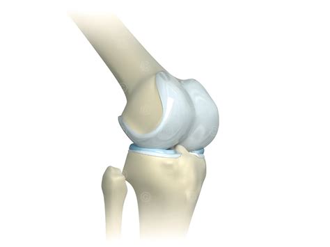 Illustration knee replacement - MedicalGraphics