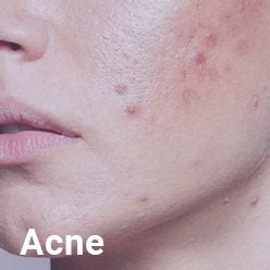 Best Skincare Brand in India | Psychodermatological Skincare