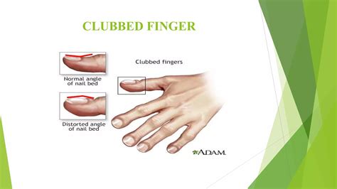 Finger clubbing, GCS Muscle Power Grading.pptx