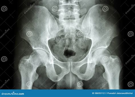 Normal Pelvis X Ray
