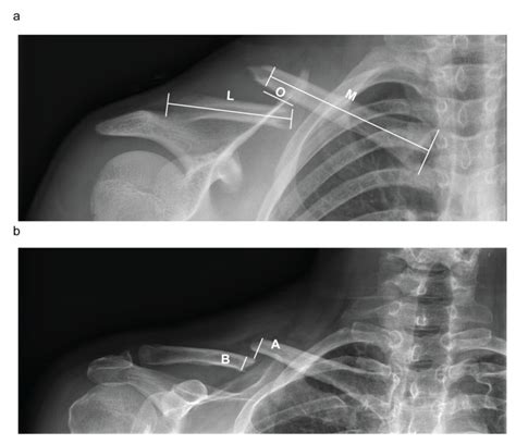 Midshaft Clavicular Fracture Management at John Ogburn blog
