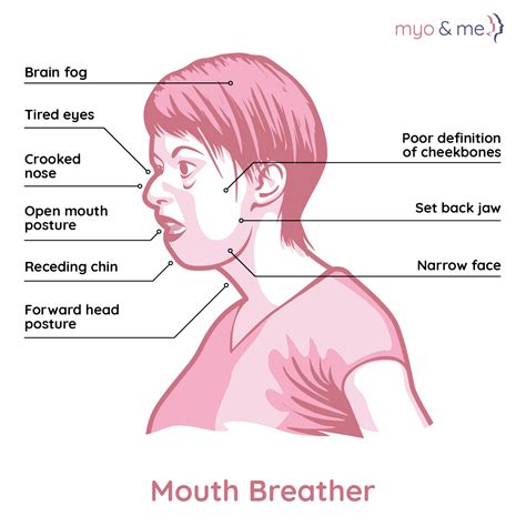 Mouth Breathing - Myo & Me