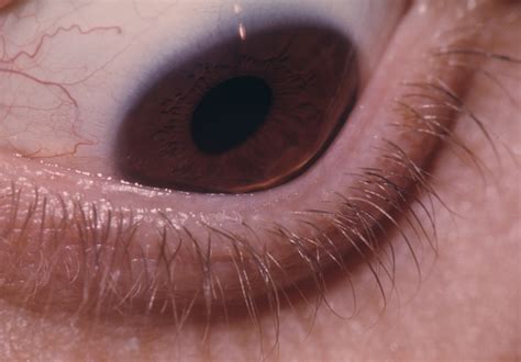Keratoconus 2 | Hereditary Ocular Diseases