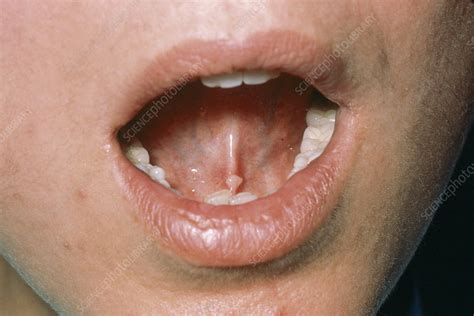 Kuvatulokset haulle blister on inner lip of mouth