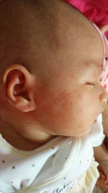 宝宝脸上有一模红_宝宝脸上湿疹图片_微信公众号文章