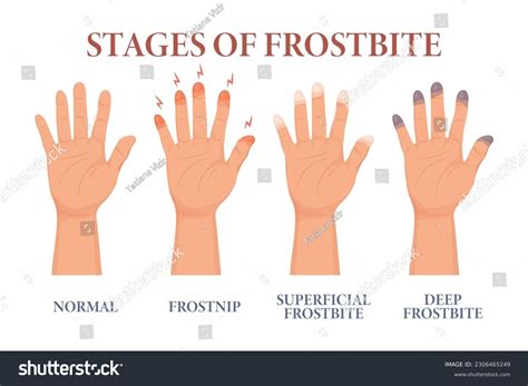 Frostbite Stages Frozen Hands Different Stages Stock Illustration 2306465249 | Shutterstock