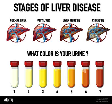 Stages of liver disease illustration Stock Vector Image & Art - Alamy