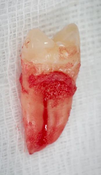 Extracting Abscessed Tooth 的图像结果