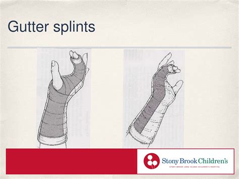 PPT - Comprehensive Guide to Splinting Techniques for Orthopedic Injuries PowerPoint ...
